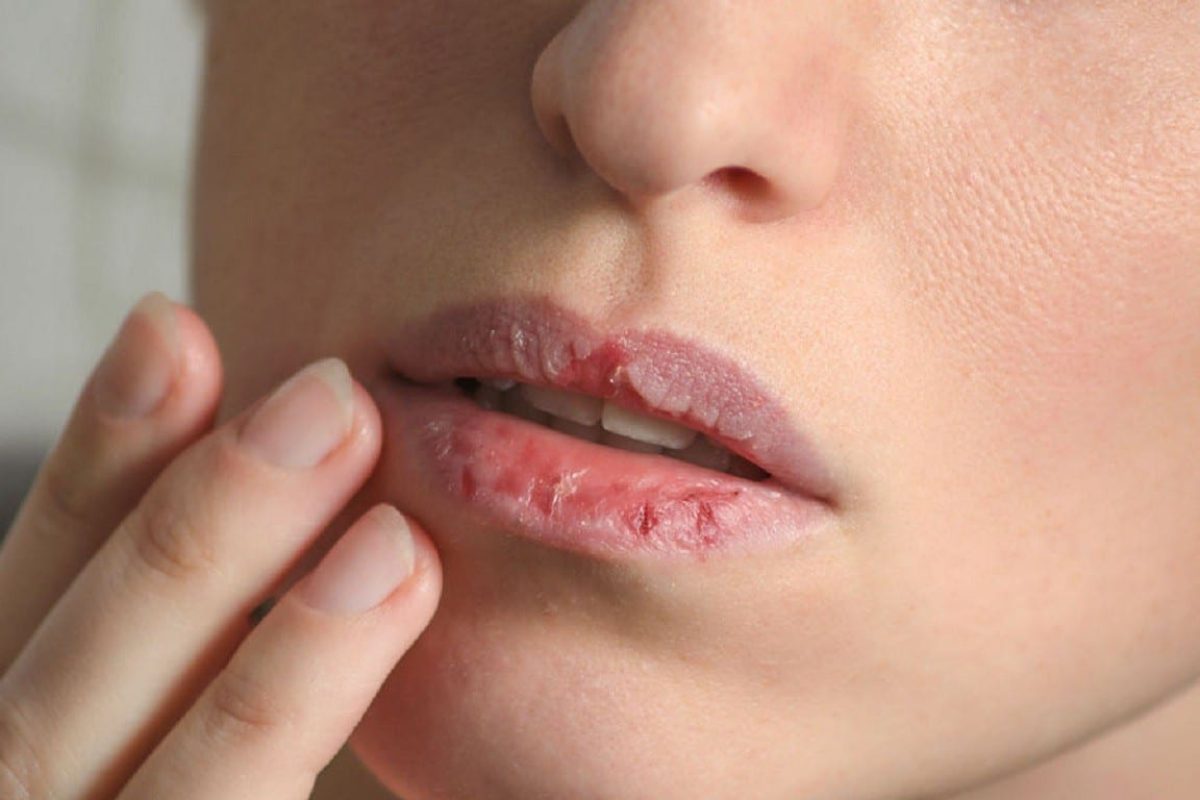 383872_948733_labios_secos_o_que_causa_como_cuidar_e_evitar_no_futuro