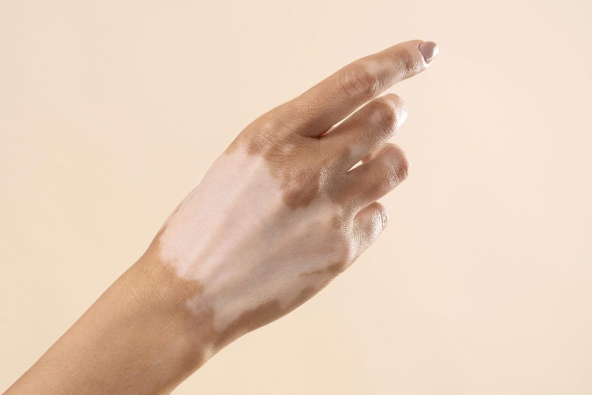 vitiligo-scaled-1